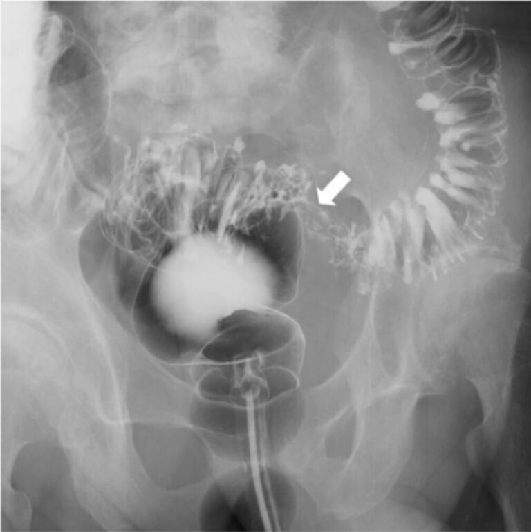 Bildgebung des Darms Röntgen, Ultraschall, CT Lecturio
