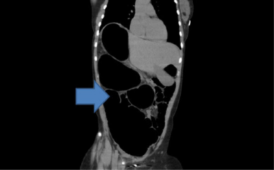Bildgebung des Darms: Röntgen, Ultraschall, CT | Lecturio