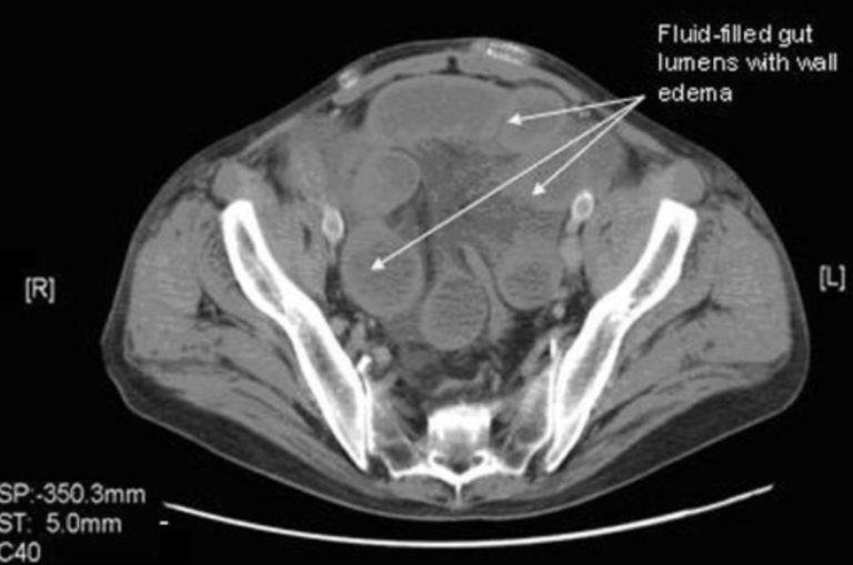 Bildgebung des Darms: Röntgen, Ultraschall, CT | Lecturio