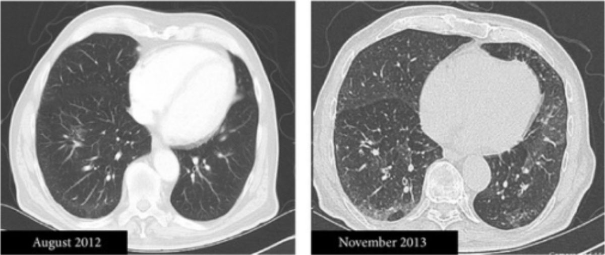 Bildgebung der Lunge: CT, MRT, Röntgen | Lecturio