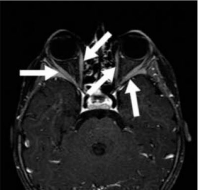 M Basedow Morbus Basedow (Graves’ Disease) - E-Learning mit Lecturio