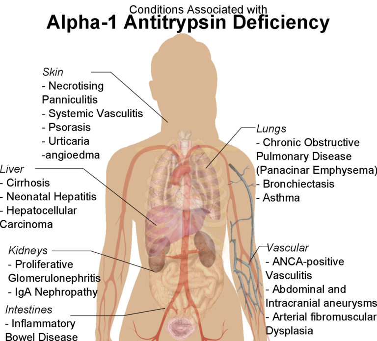 Alpha 1 Antitrypsin Mangel Symptome