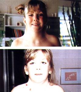 Turner Syndrom Klinik Und Genetik Lecturio
