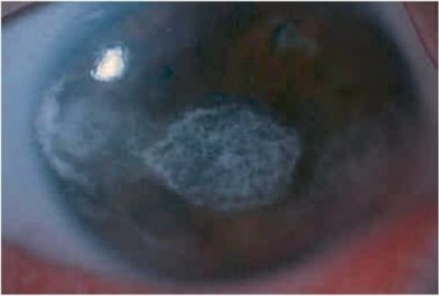Uveitis ELearning mit Lecturio