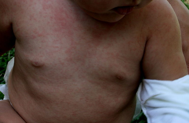 Humanes Herpesvirus 6 und 7 Vergleich Lecturio