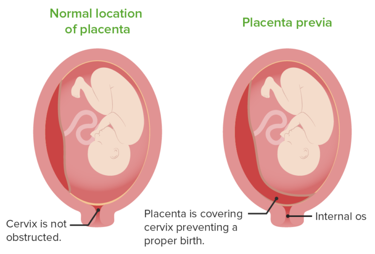 Plazenta Pathologien E Learning Mit Lecturio plazenta-pathologien-e-learning-mit-lecturio