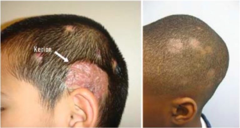 Alopezie ELearning mit Lecturio
